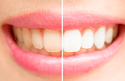 teeth whitening breese illinois