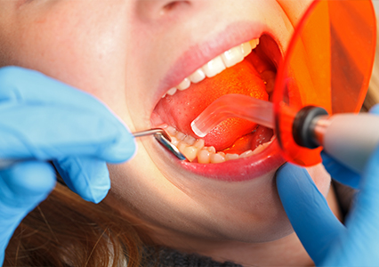 dental sealants for preventative dentistry highland illinois