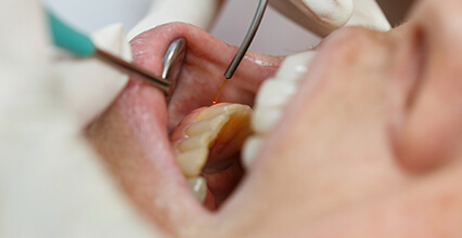 dental laser treatment near highland illinois