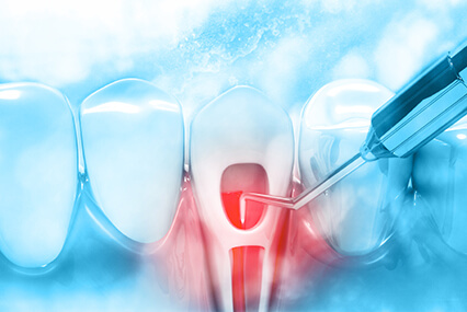 root canal treatment highland illinois