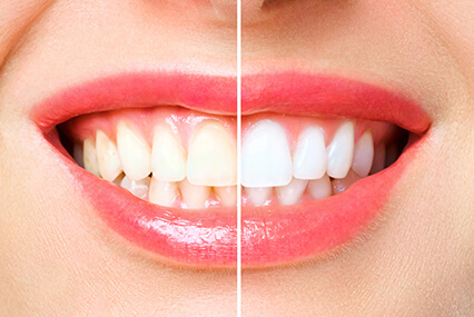 teeth whitening cosmetic dentistry